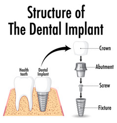 Structure of the dental implant on white Vector Image