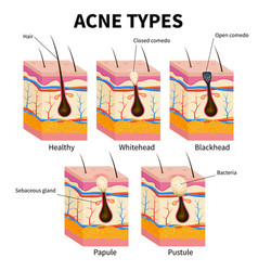 Different types of injections Royalty Free Vector Image