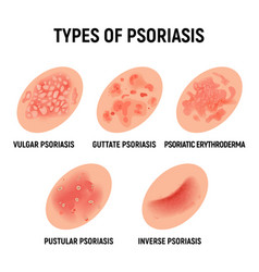 Psoriasis rash skin hand infection Royalty Free Vector Image