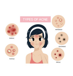 Girl type acne Royalty Free Vector Image - VectorStock