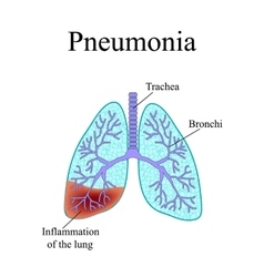 Pneumonia The anatomical structure of the human Vector Image