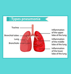 Scientific medical tuberculosis tb Royalty Free Vector Image