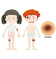 boy and girl with bruise vector image vector image