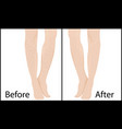 before and after hair removal methods results vector image