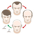 stages hair loss treatment and transplantation vector image