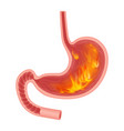 realistic medical of pyrosis stomach vector image