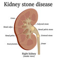 Renal system and kidney stones Royalty Free Vector Image