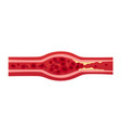blocked blood vessel artery with cholesterol vector image