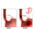 gastritis and esophageal ulcer vector image