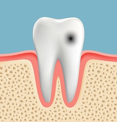 Image a human tooth with caries Royalty Free Vector Image